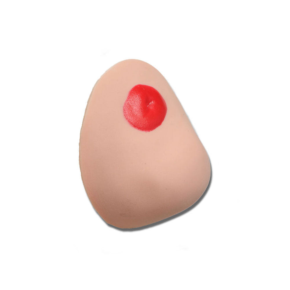 Parastomal Hernia Stoma For Use With Otto Ostomy