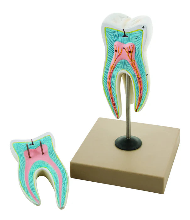 Upper Triple Root Molar Model with Caries – 15x Enlarged, 2-Parts