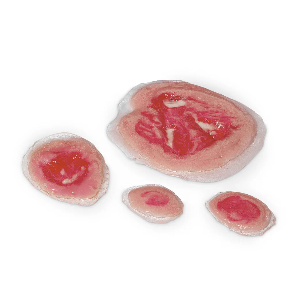 Pressure Ulcers