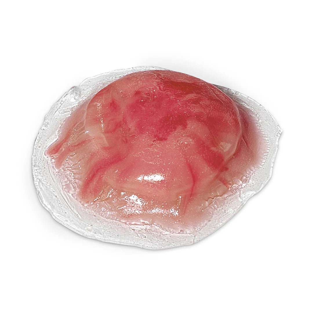 Cyst Pus-Filled