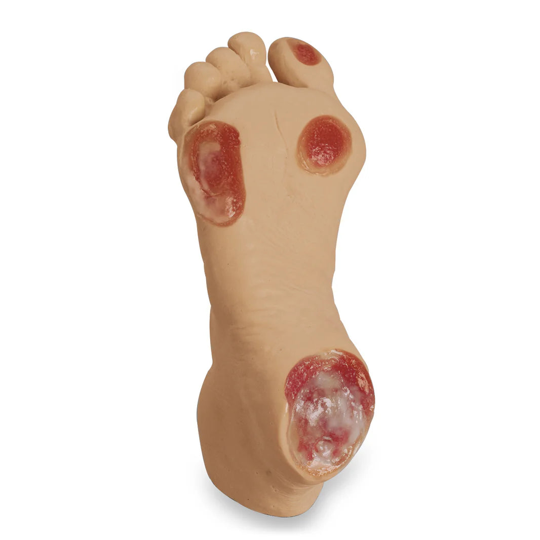 Pressure Ulcer Foot