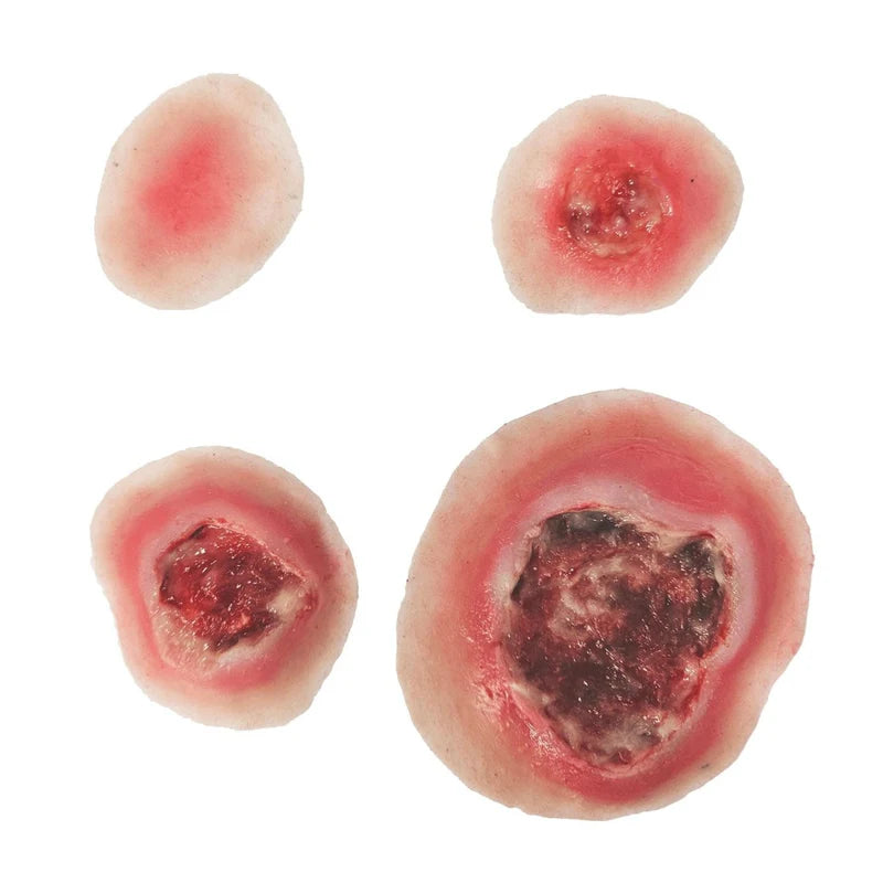 Sheet Bedsores 4 Stages
