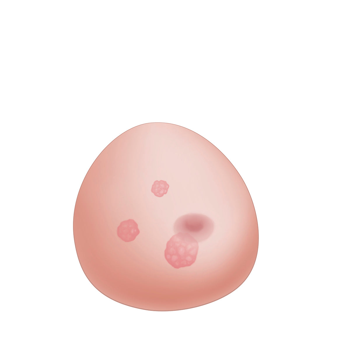 SONOtrain™ Breast Model