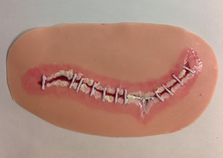 Surgical Site Infection Level 2