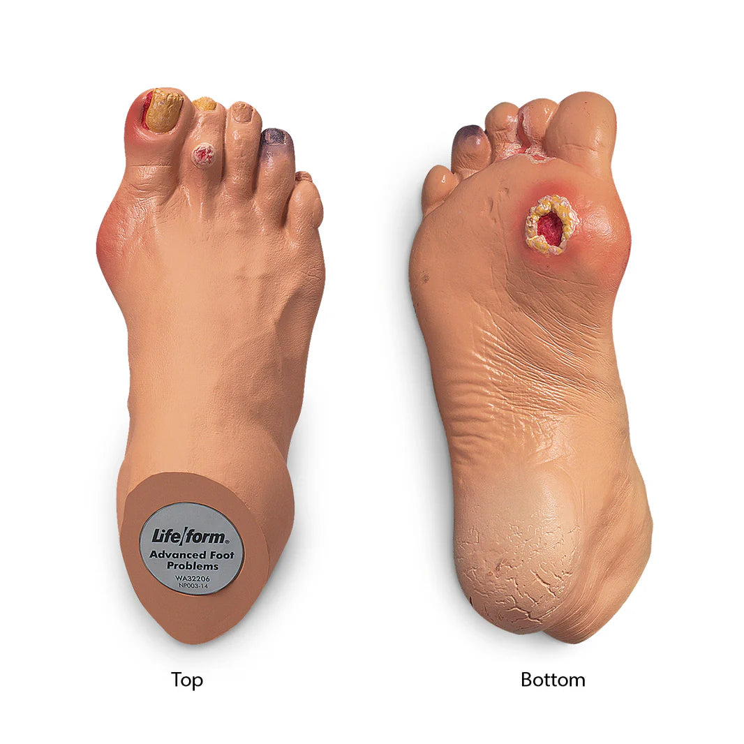Advanced Foot Problems