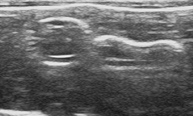 Femoral Artery Puncture Training Model