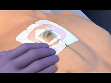 3M Tegaderm CHG Port Securement Dressing