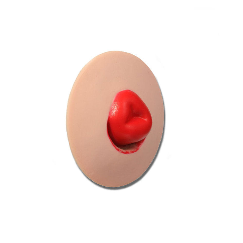 Mucocutaneous Separation Stoma For Use With Otto Ostomy