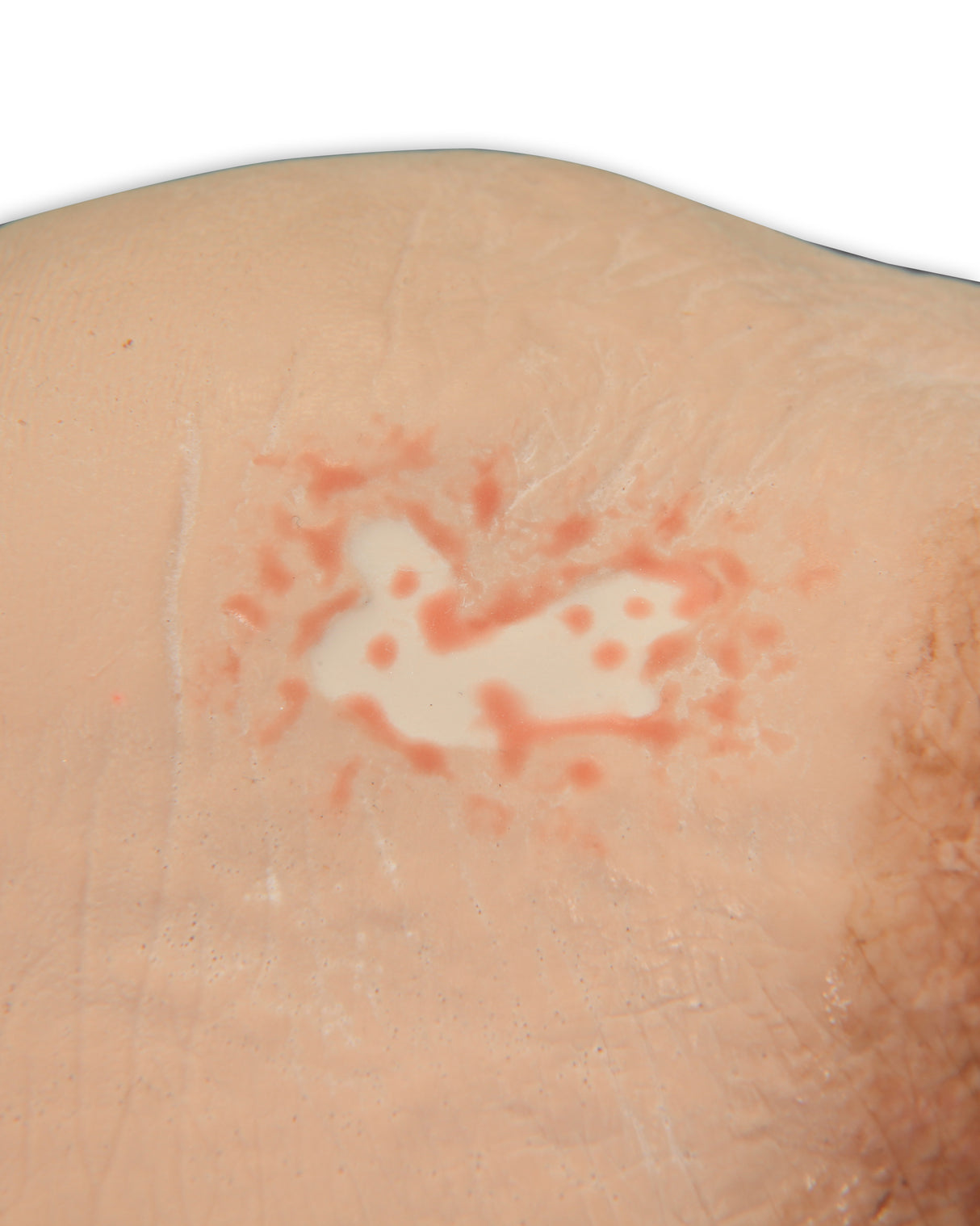 Vinnie Venous Insufficiency Leg Model