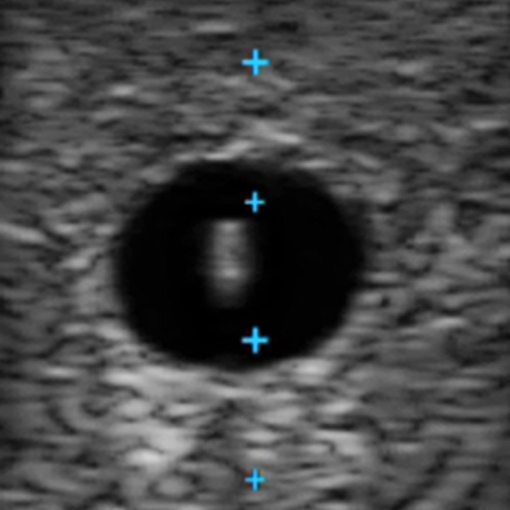 Vascular Access Ultrasound Phantom (4 Vein Bifurcated W/ Deep Vein)