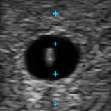 Vascular Access Ultrasound Phantom (4 Vein Bifurcated W/ Deep Vein)