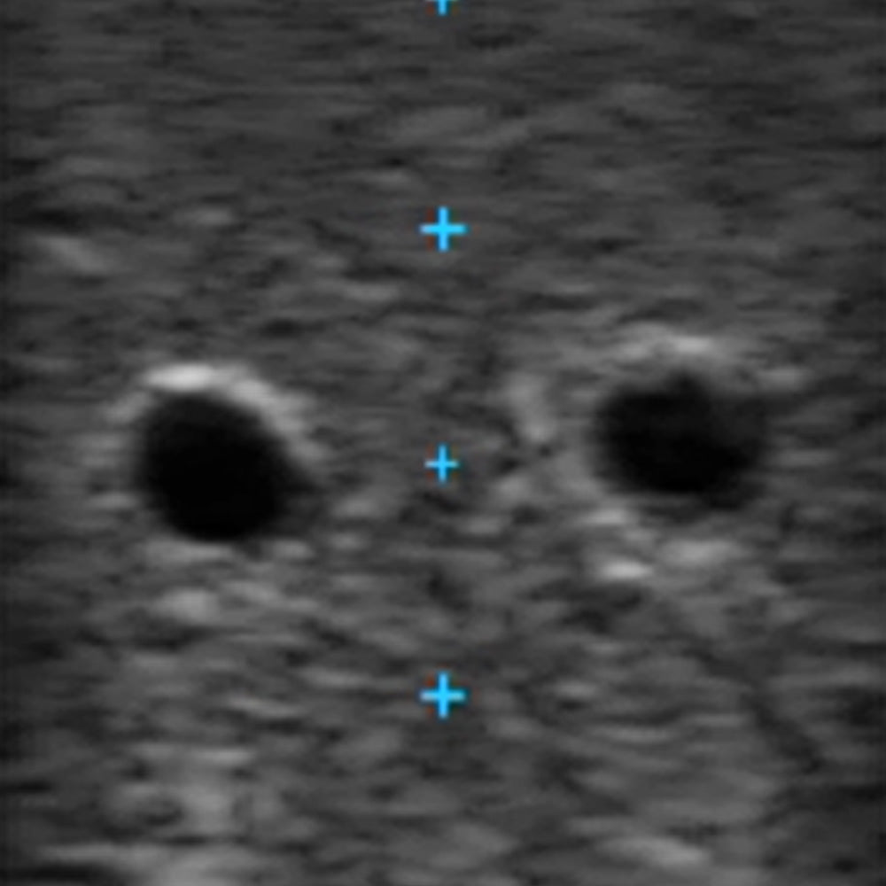 Vascular Access Ultrasound Phantom (4 Vein Bifurcated W/ Deep Vein)