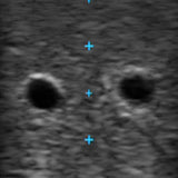 Vascular Access Ultrasound Phantom (4 Vein Bifurcated W/ Deep Vein)