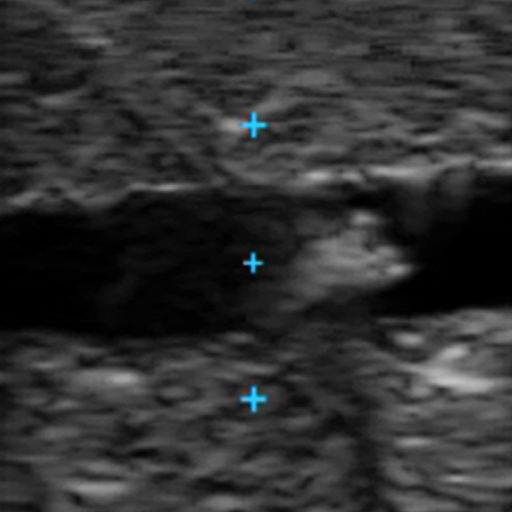 Vascular Access Ultrasound Phantom (4 Vein Bifurcated W/ Deep Vein)
