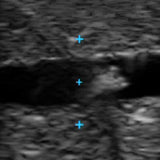 Vascular Access Ultrasound Phantom (4 Vein Bifurcated W/ Deep Vein)