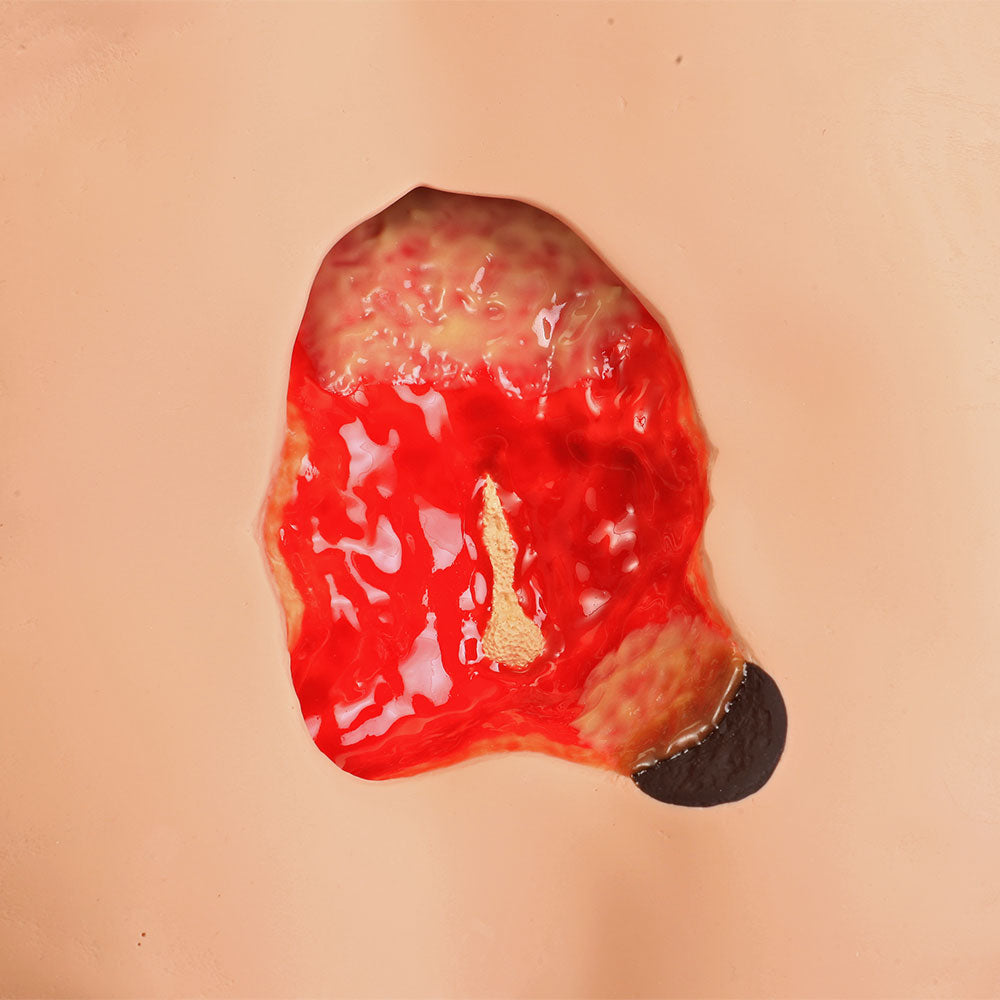 Stan Stage 4 Sacral Pressure Injury Model™