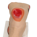 Wilma Wound Foot™