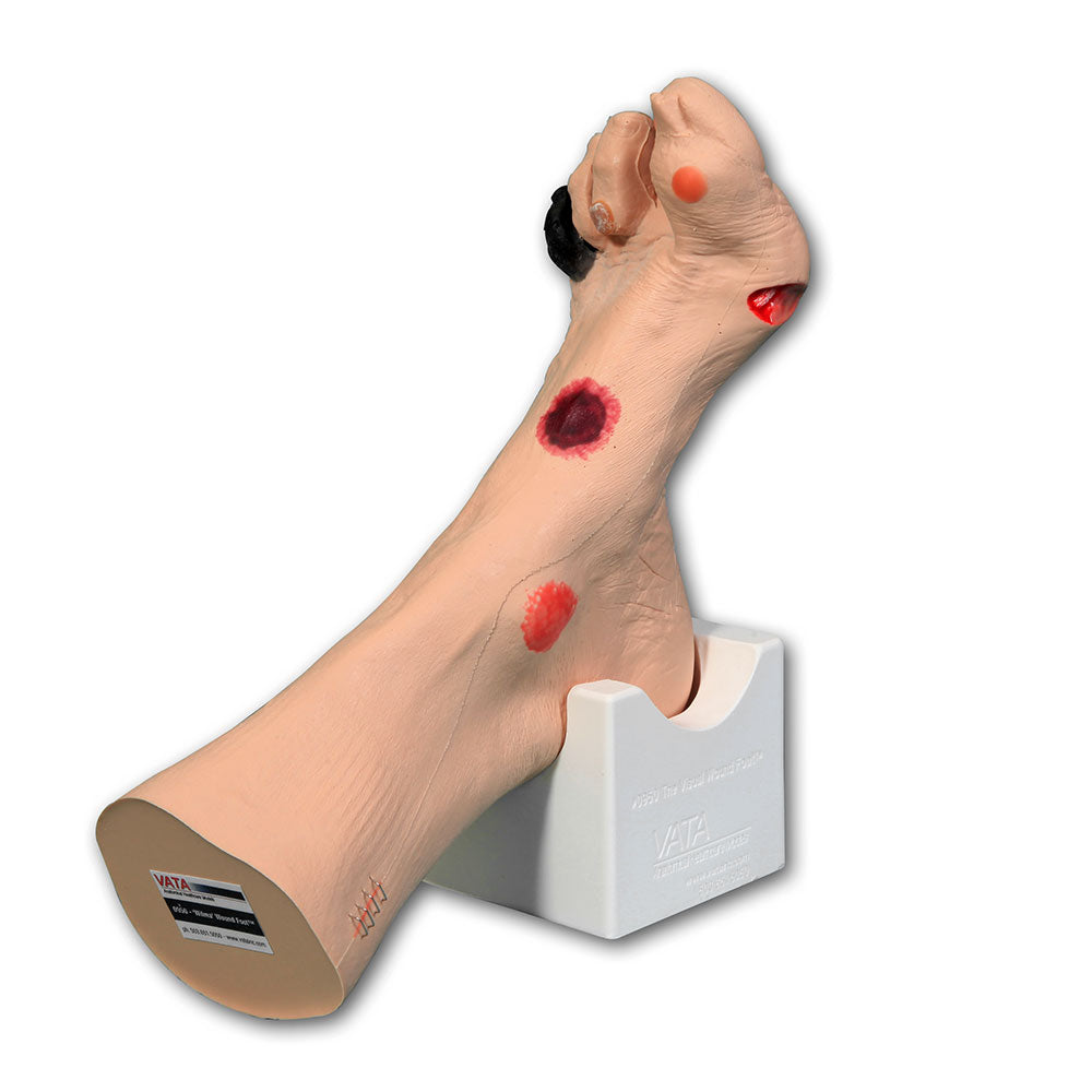 Wilma Wound Foot™