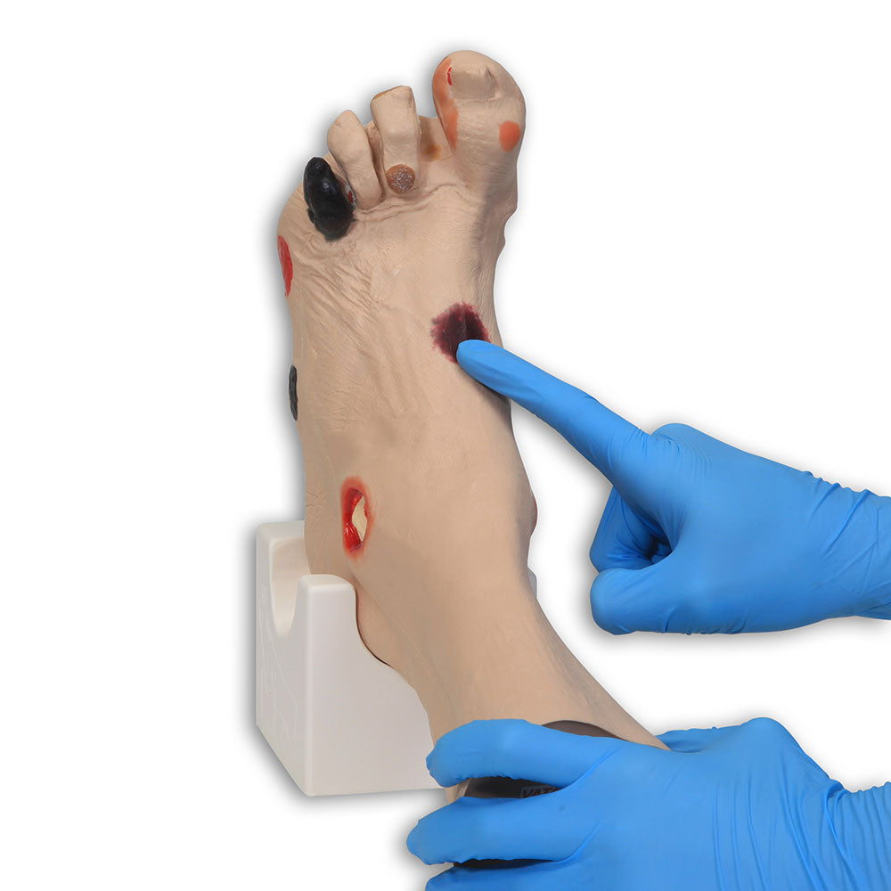 Wilma Wound Foot™