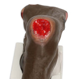Wilma Wound Foot™