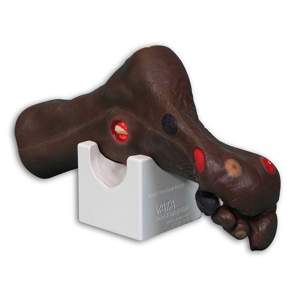 Wilma Wound Foot™