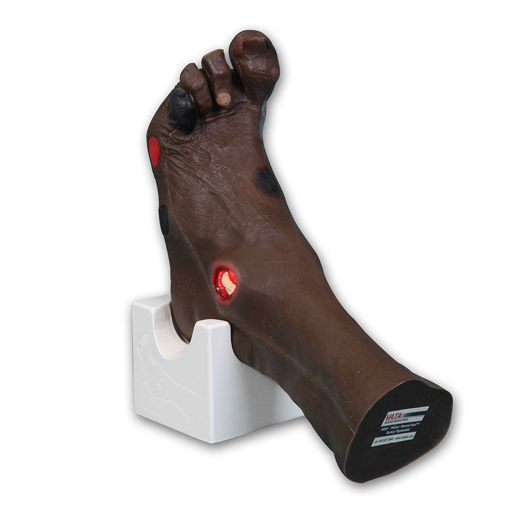 Wilma Wound Foot™
