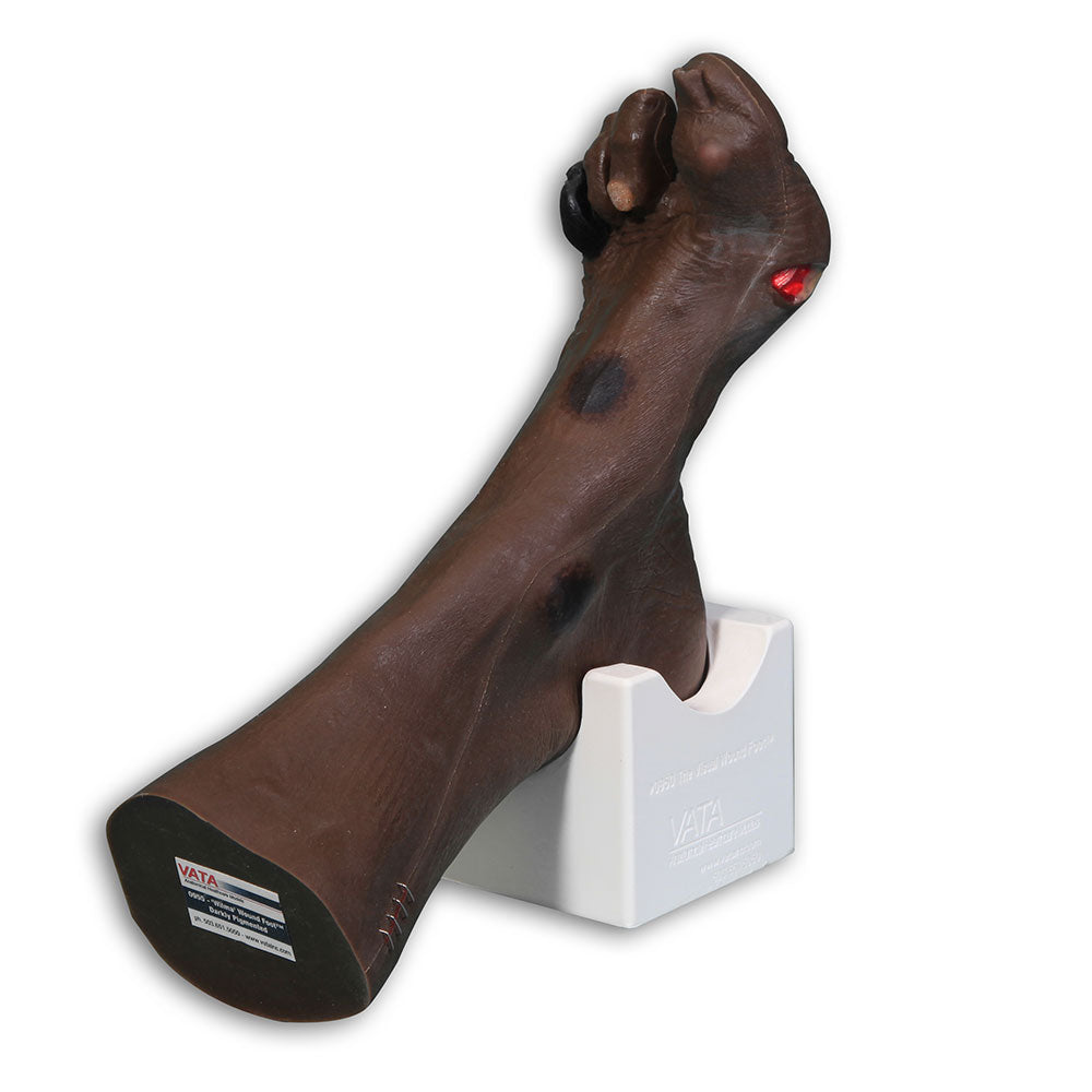 Wilma Wound Foot™