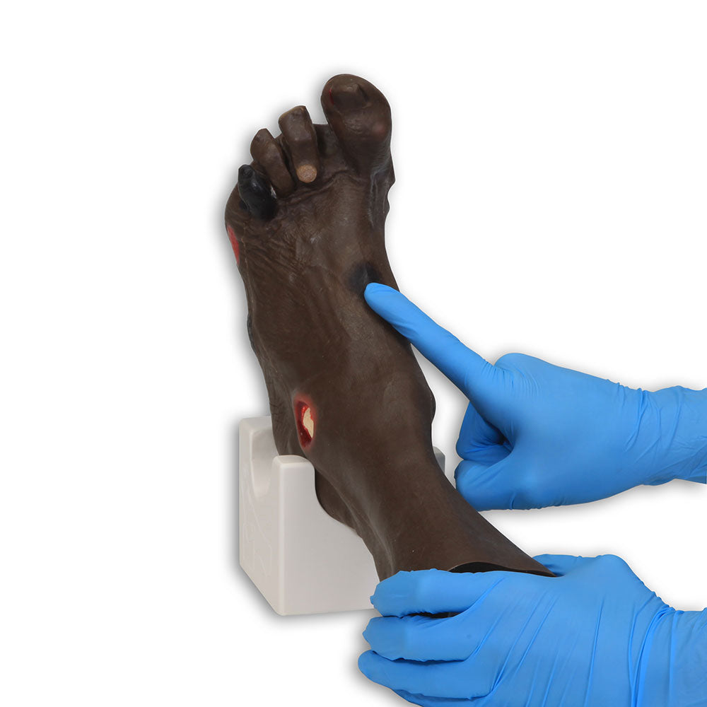 Wilma Wound Foot™