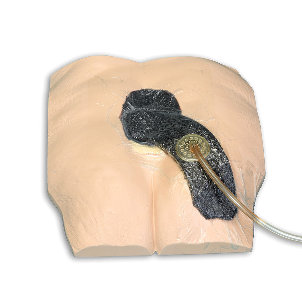 Stan Stage 4 Sacral Pressure Injury Model™