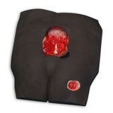 Stan Stage 4 Sacral Pressure Injury Model™