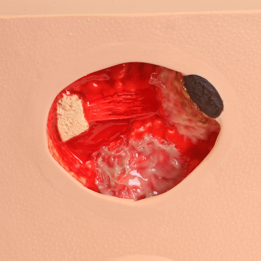 Pat Pressure Injury Staging Model™