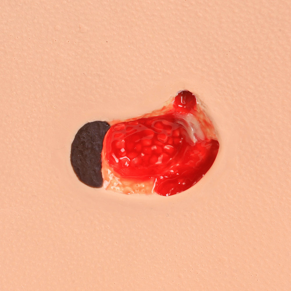 Pat Pressure Injury Staging Model™