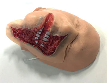 Exposed Denture Avulsion