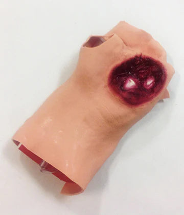 Gunshot Wound Of The Palm