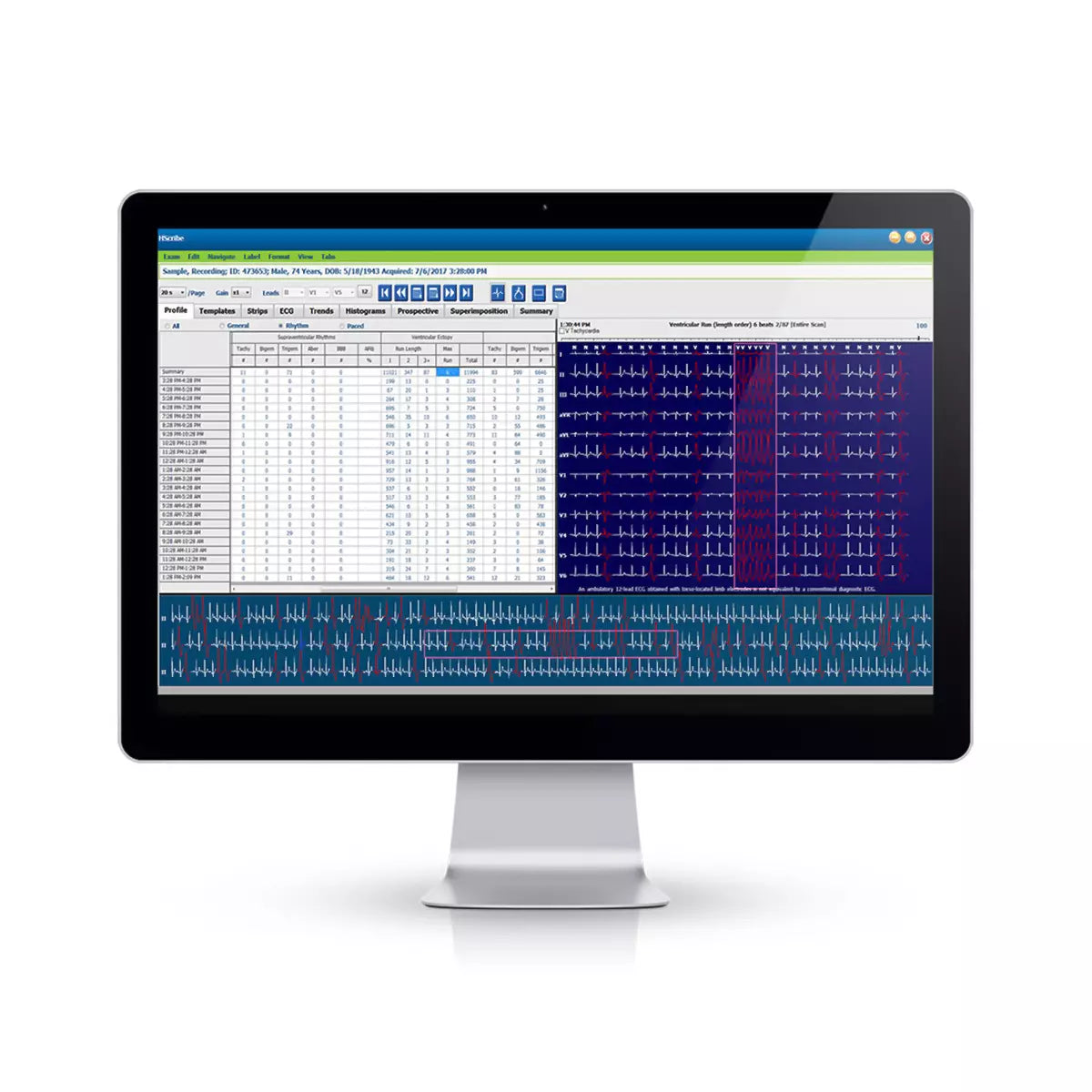 HSCRIBE Holter Analysis System