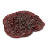 Blood Clot