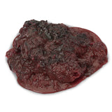 Blood Clot
