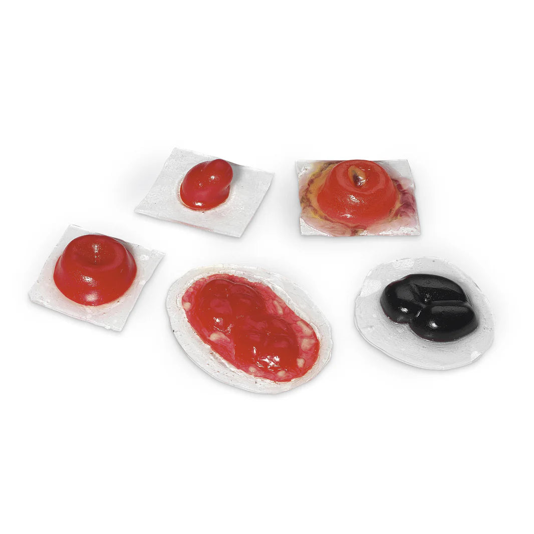 Ostomies
