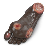 Pressure Ulcer Foot