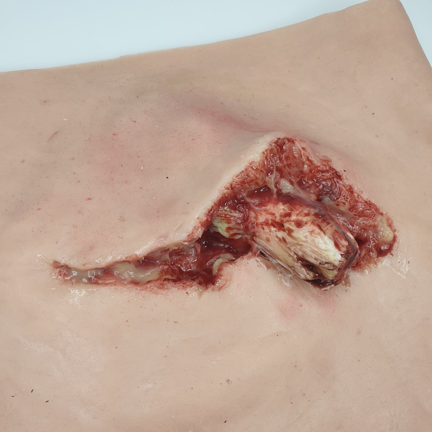 Protruding Femur Fracture