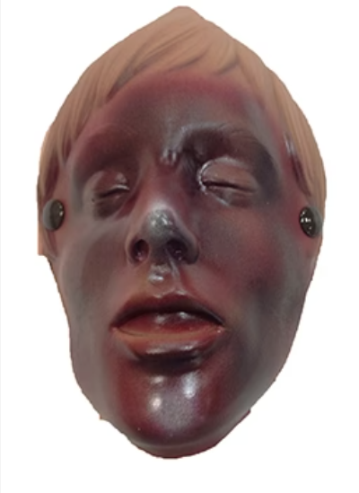 Burn Of The Face (Manikin Use)