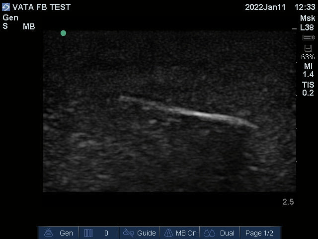 Ultrasound Phantom Foreign Body