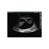 Blue Phantom Amniocentesis Ultrasound Training Model