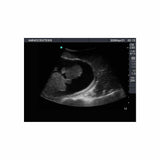 Blue Phantom Amniocentesis Ultrasound Training Model