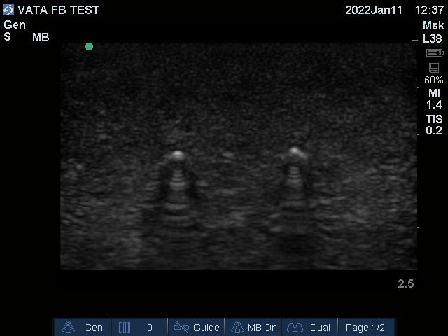 Ultrasound Phantom Foreign Body