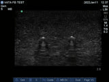 Ultrasound Phantom Foreign Body