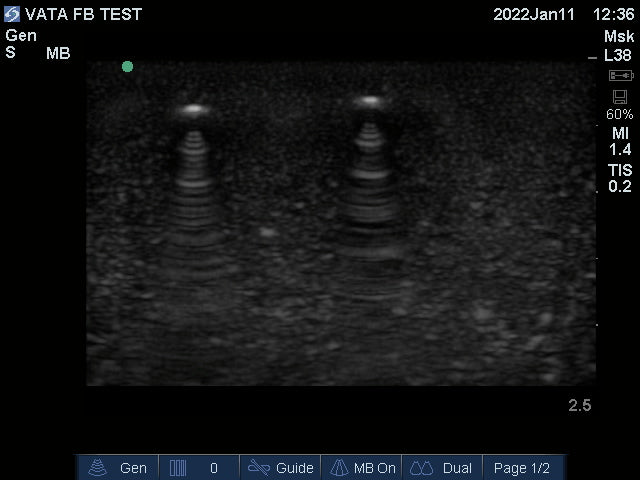 Ultrasound Phantom Foreign Body