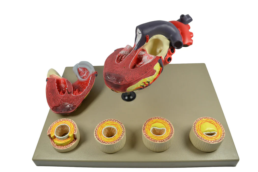 Human Heart Conditions Pathology