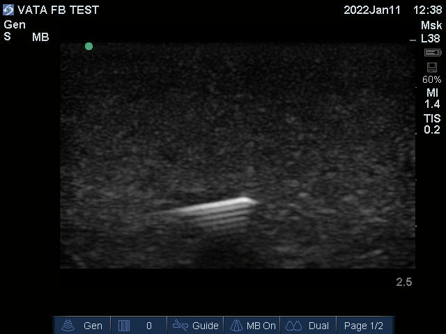 Ultrasound Phantom Foreign Body