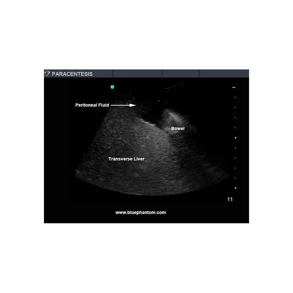 Blue Phantom Paracentesis Ultrasound Training Model